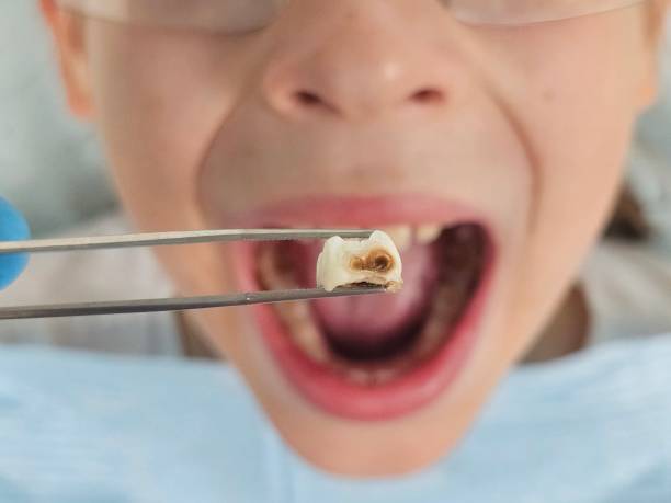 Best Knocked-Out Tooth (Avulsed Tooth) Treatment in North Kingsville, OH